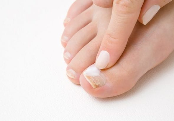 Laser Toenail Fungus Treatment- What You Need To Know
